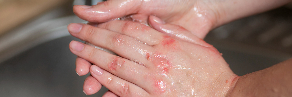 Как ухаживать за атопичной кожей Как ухаживать за атопичной кожей